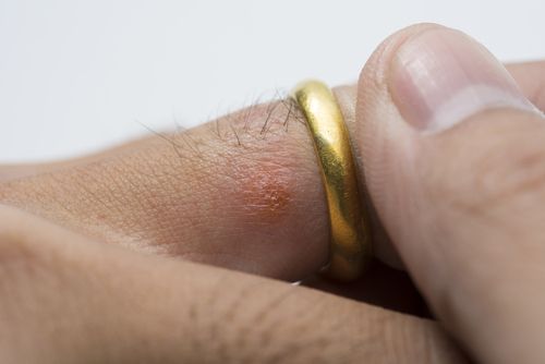 Ring/Metal Allergy