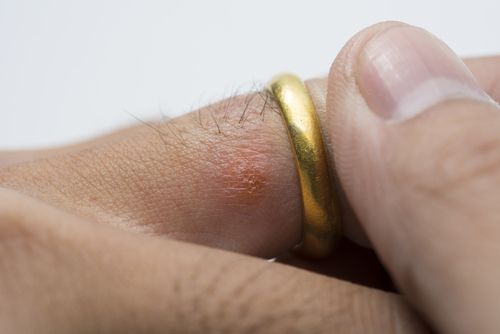 Can t Wear Your Wedding Ring You Could Have a Metal Allergy Get